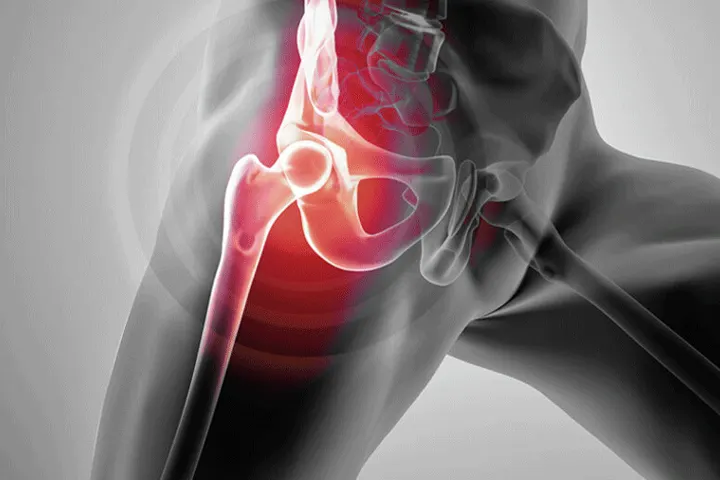 آرتروز مفاصل چیست؟ بررسی علل، پیشگیری و درمان‌های نوین
